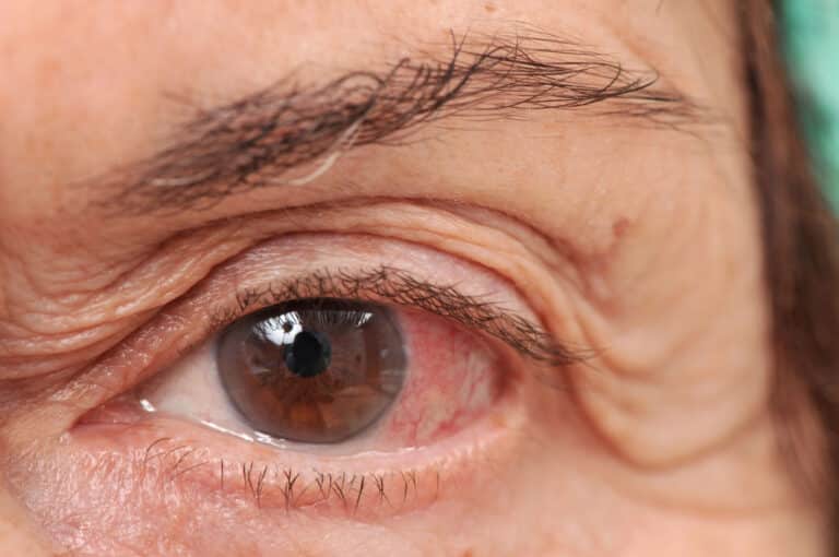 Care management services can help get aging seniors with eye issues the care they need to age in place safely.